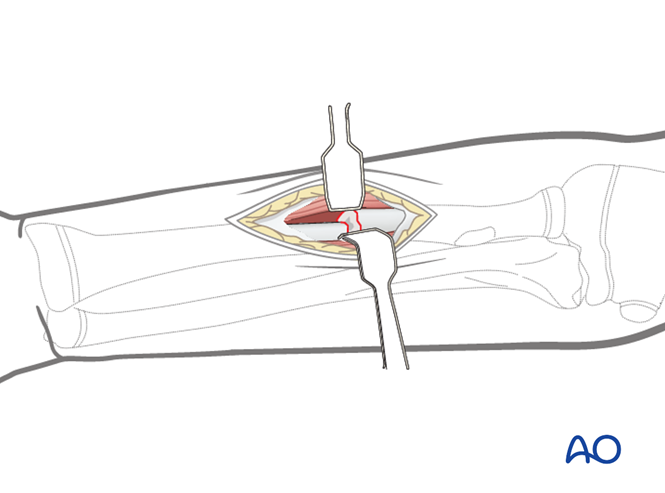 【手术技术】儿童尺桡骨双骨折的弹性髓内钉内固定（AO官网指南）