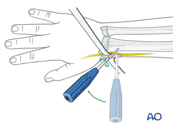 【手术技术】儿童尺桡骨双骨折的弹性髓内钉内固定（AO官网指南）
