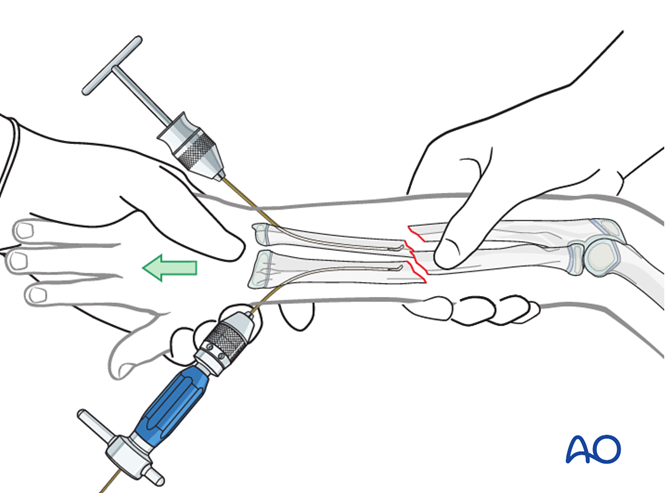 【手术技术】儿童尺桡骨双骨折的弹性髓内钉内固定（AO官网指南）