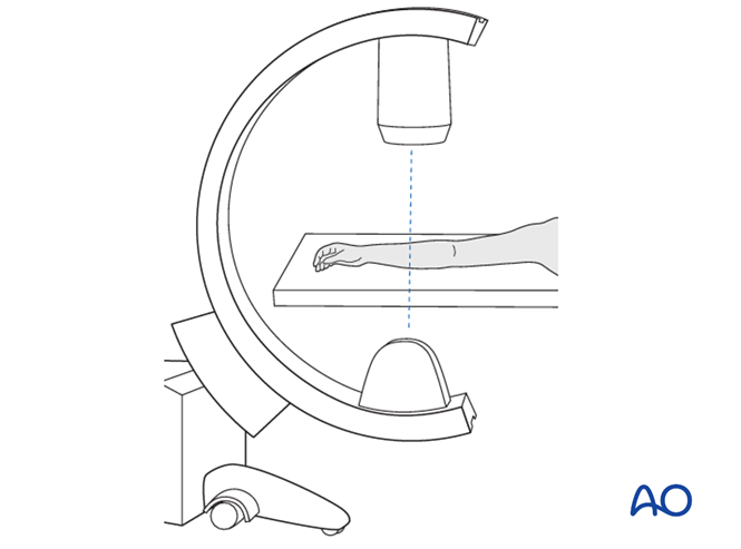 【手术技术】儿童尺桡骨双骨折的弹性髓内钉内固定（AO官网指南）