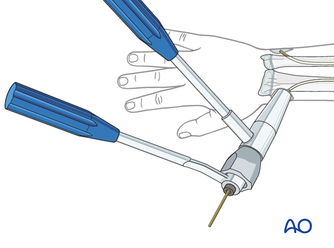 【手术技术】儿童尺桡骨双骨折的弹性髓内钉内固定（AO官网指南）