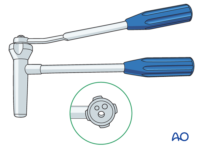 【手术技术】儿童尺桡骨双骨折的弹性髓内钉内固定（AO官网指南）