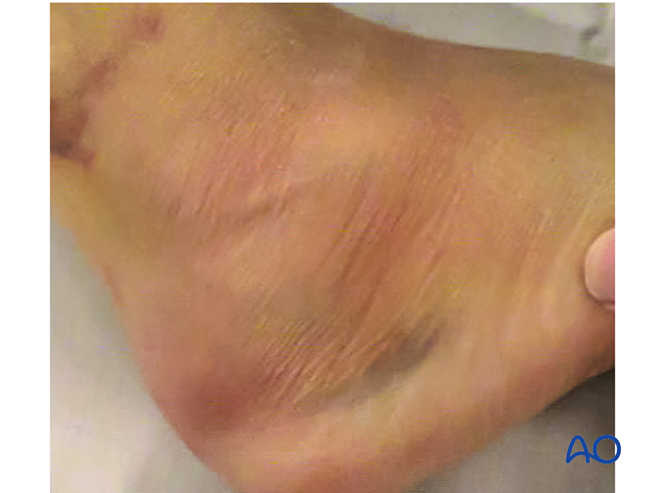 跟骨的外侧扩大入路——大L形切口