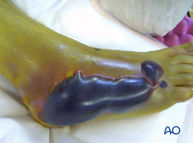 跟骨的外侧扩大入路——大L形切口