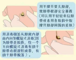 医用脐带包怎么用【吴桥县人民医院微科普】新手爸妈小知识----新生儿脐部护理_https://www.jmylbn.com_新闻资讯_第13张