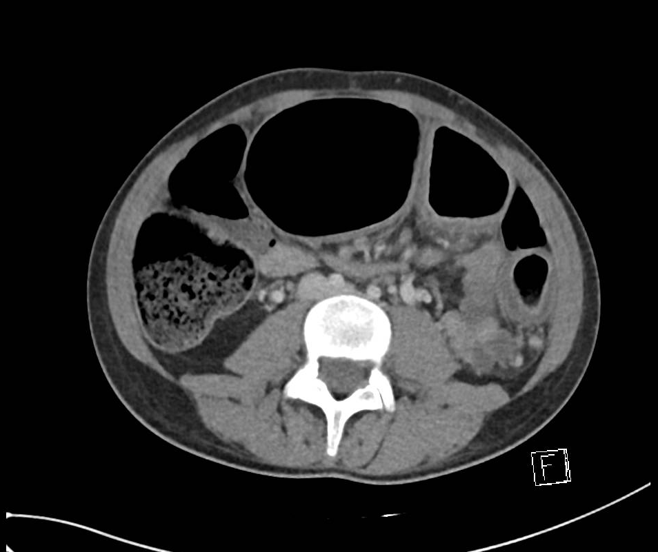 中毒性巨结肠,你见过吗?_医学界-助力医生临床决策和职业成长