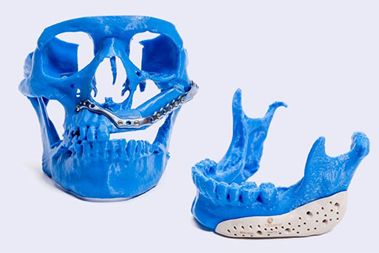 医疗 | 定制外科植入物，仿真助力修复患者骨缺损的图1