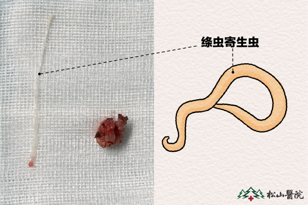 72岁老人眼疾背后惊现“寄生虫”，眼科医生揭开真相！