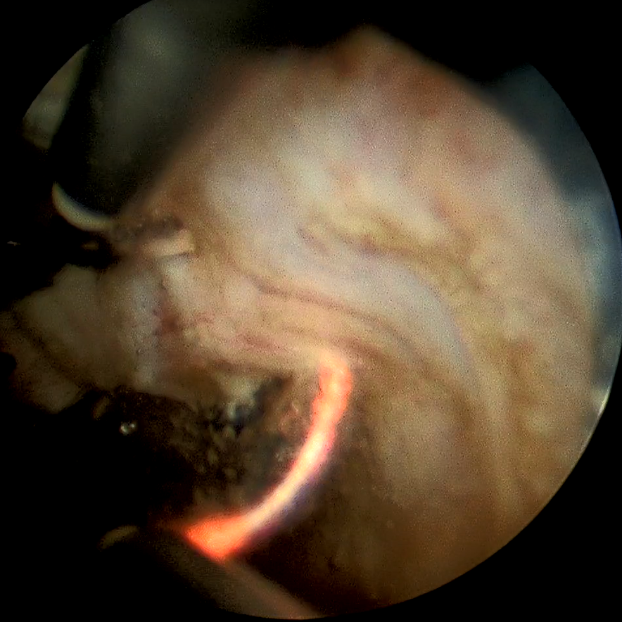 腰痛被误诊？前列腺增生别忽视！