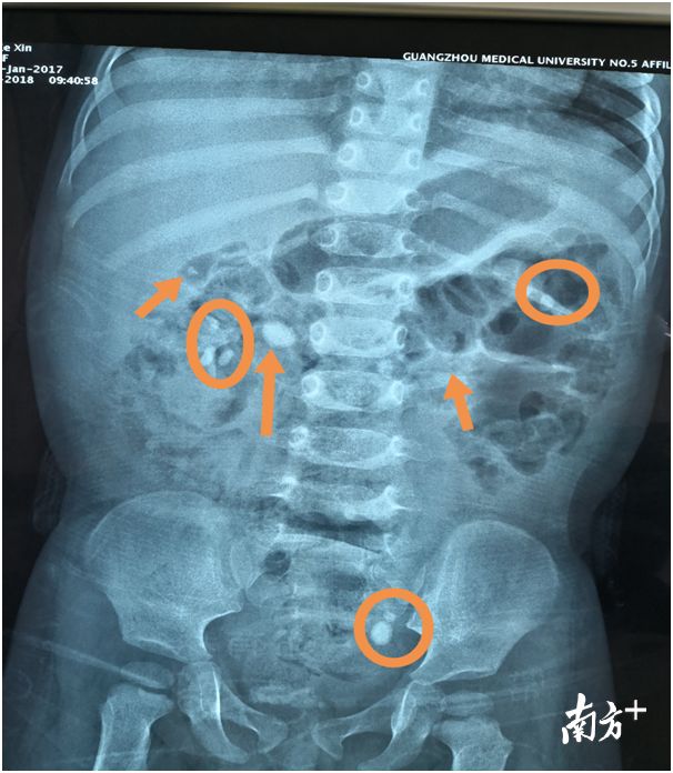 



一岁女童双肾长满结石 只因家长做错这件事
