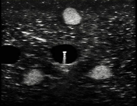 为什么20ml针筒的针在边上【静疗圈】超声引导下穿刺看不到针尖怎么办？_https://www.jmylbn.com_新闻资讯_第6张
