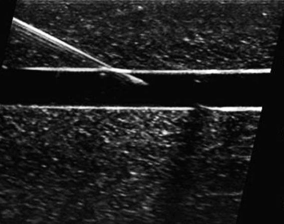 为什么20ml针筒的针在边上【静疗圈】超声引导下穿刺看不到针尖怎么办？_https://www.jmylbn.com_新闻资讯_第7张