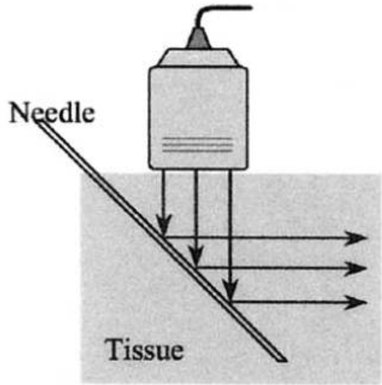 为什么20ml针筒的针在边上【静疗圈】超声引导下穿刺看不到针尖怎么办？_https://www.jmylbn.com_新闻资讯_第2张