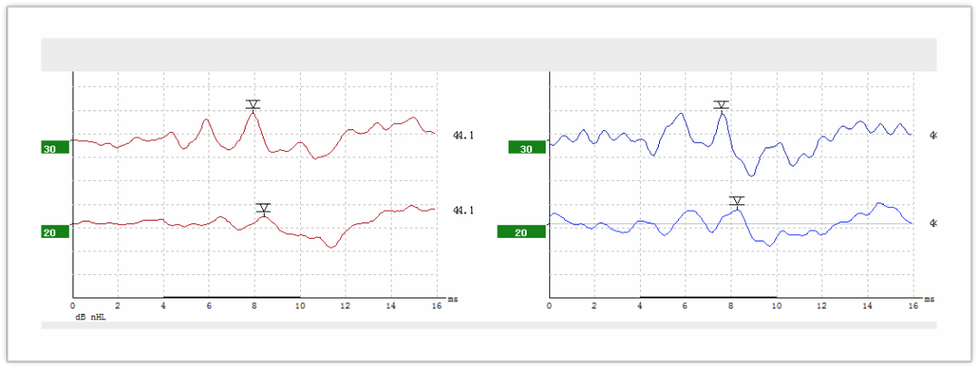 听力AC为什么0临床听力学技术专业沙龙 ｜ 傅新星：AEP临床应用和新进展_https://www.jmylbn.com_新闻资讯_第17张