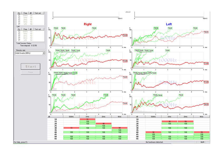 听力AC为什么0临床听力学技术专业沙龙 ｜ 傅新星：AEP临床应用和新进展_https://www.jmylbn.com_新闻资讯_第23张
