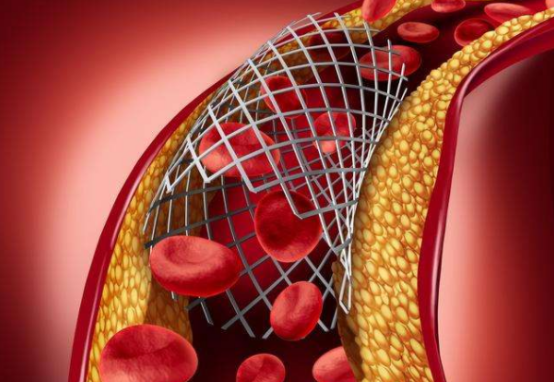 缺血适应训练仪怎么心脏支架手术危险吗？预适应训练仪辅助术后康复_https://www.jmylbn.com_新闻资讯_第3张