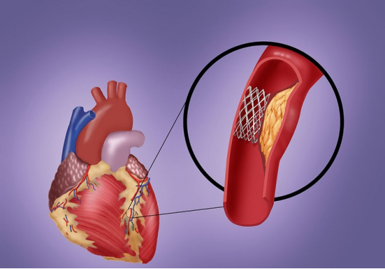 缺血适应训练仪怎么心脏支架手术危险吗？预适应训练仪辅助术后康复_https://www.jmylbn.com_新闻资讯_第5张