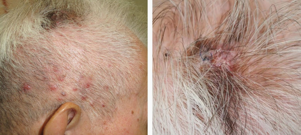 头皮结节伴毛发变黑1个月,会是什么病?