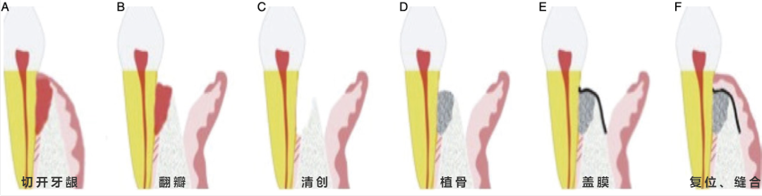 电刀怎么洗我以为只要洗个牙，医生你怎么还拿起了手术刀？_https://www.jmylbn.com_新闻资讯_第7张