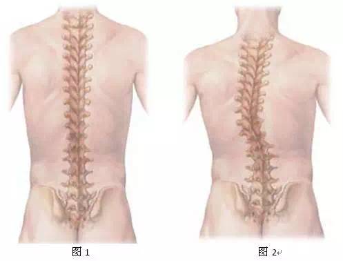 导致驼背,脊柱弯曲变形则会影响其脊柱的发育处于生长发育期的儿童