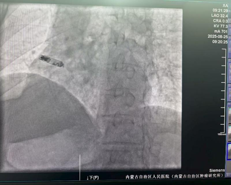 心脏是怎么固定的“心”希望，“新”动力 内蒙古自治区人民医院率先启用单心房主动固定无导线起搏器，引领心脏起搏技术新纪元_https://www.jmylbn.com_新闻资讯_第6张