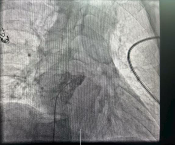 心脏是怎么固定的“心”希望，“新”动力 内蒙古自治区人民医院率先启用单心房主动固定无导线起搏器，引领心脏起搏技术新纪元_https://www.jmylbn.com_新闻资讯_第4张