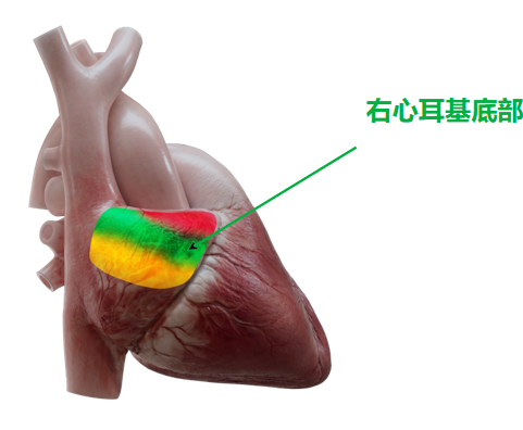 心脏是怎么固定的“心”希望，“新”动力 内蒙古自治区人民医院率先启用单心房主动固定无导线起搏器，引领心脏起搏技术新纪元_https://www.jmylbn.com_新闻资讯_第10张