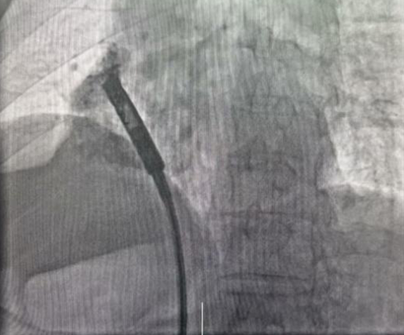 心脏是怎么固定的“心”希望，“新”动力 内蒙古自治区人民医院率先启用单心房主动固定无导线起搏器，引领心脏起搏技术新纪元_https://www.jmylbn.com_新闻资讯_第5张