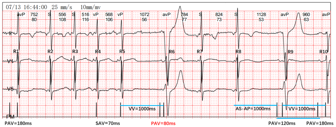 为什么双极不起博热点文章｜李则林：起搏器PAV间期80ms现象_https://www.jmylbn.com_新闻资讯_第7张