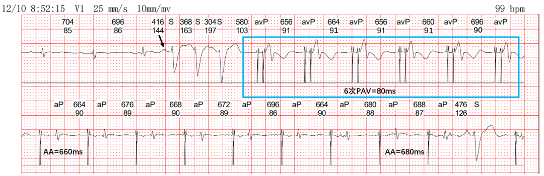 为什么双极不起博热点文章｜李则林：起搏器PAV间期80ms现象_https://www.jmylbn.com_新闻资讯_第3张