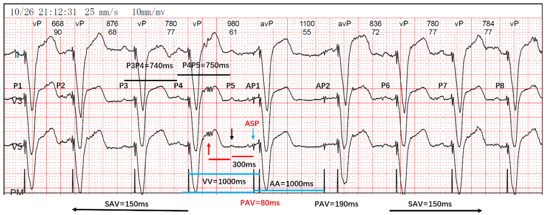 为什么双极不起博热点文章｜李则林：起搏器PAV间期80ms现象_https://www.jmylbn.com_新闻资讯_第1张