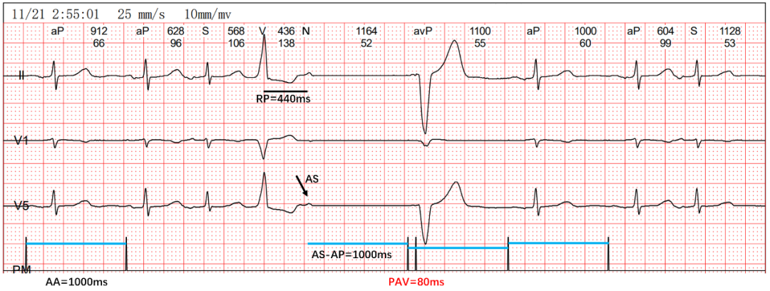 为什么双极不起博热点文章｜李则林：起搏器PAV间期80ms现象_https://www.jmylbn.com_新闻资讯_第9张