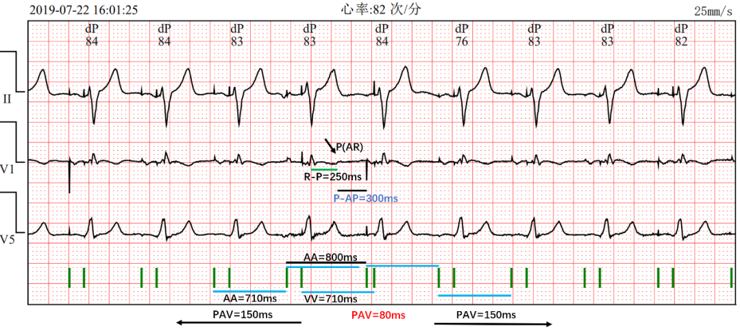 为什么双极不起博热点文章｜李则林：起搏器PAV间期80ms现象_https://www.jmylbn.com_新闻资讯_第11张