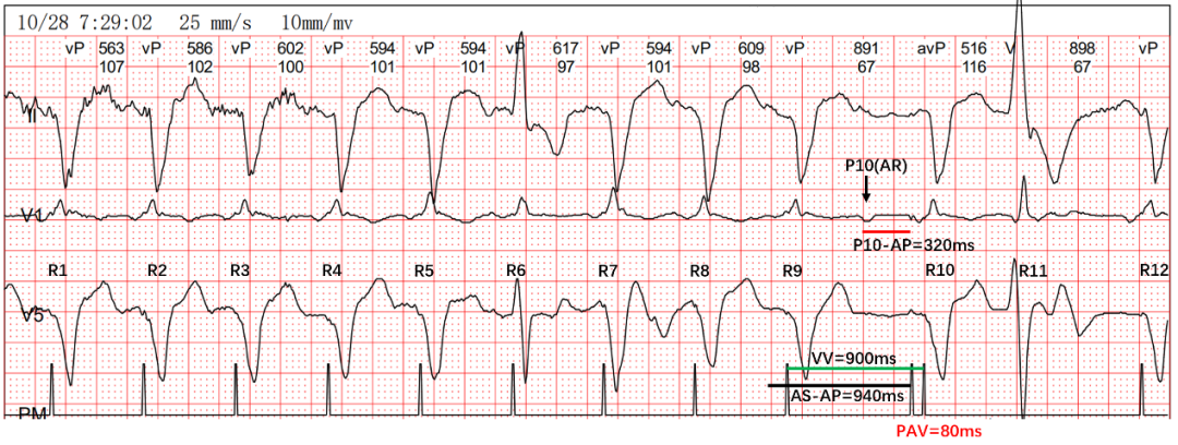 为什么双极不起博热点文章｜李则林：起搏器PAV间期80ms现象_https://www.jmylbn.com_新闻资讯_第13张
