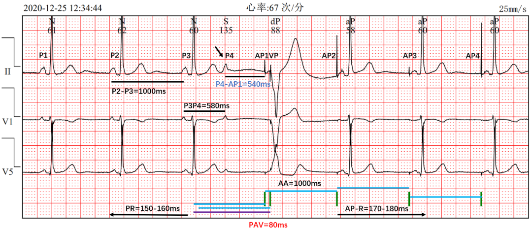 为什么双极不起博热点文章｜李则林：起搏器PAV间期80ms现象_https://www.jmylbn.com_新闻资讯_第5张