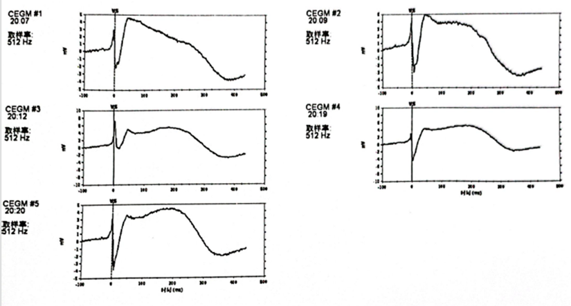 心脏是怎么固定的“螺旋固定，无线心动”——新型主动螺旋固定式无导线心脏起搏器植入术案例分享_https://www.jmylbn.com_新闻资讯_第15张
