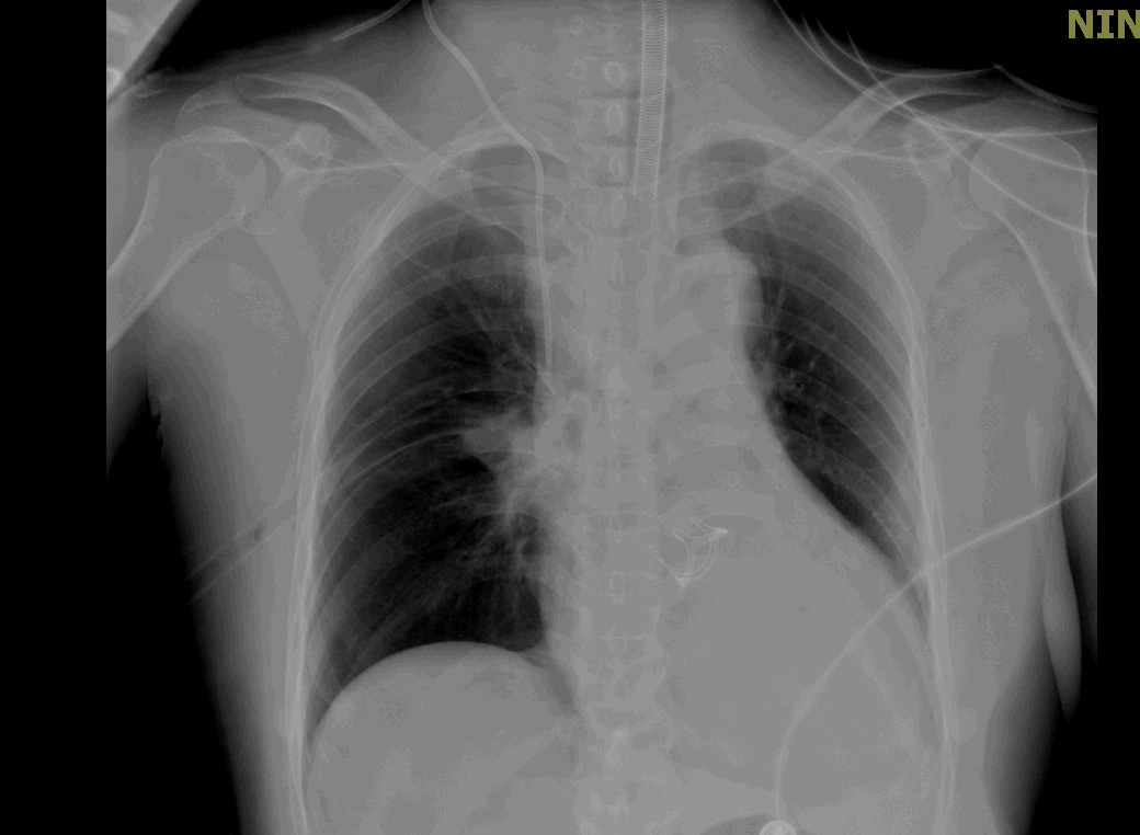 为什么叫哈巴狗钳2023学术荟萃｜王云：右侧肋间小切口体外循环心脏手术_https://www.jmylbn.com_新闻资讯_第15张