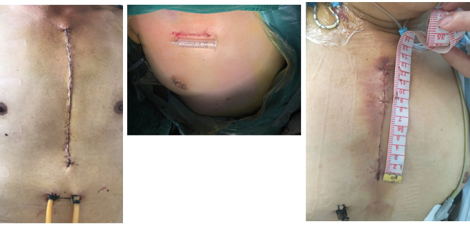 为什么叫哈巴狗钳2023学术荟萃｜王云：右侧肋间小切口体外循环心脏手术_https://www.jmylbn.com_新闻资讯_第5张