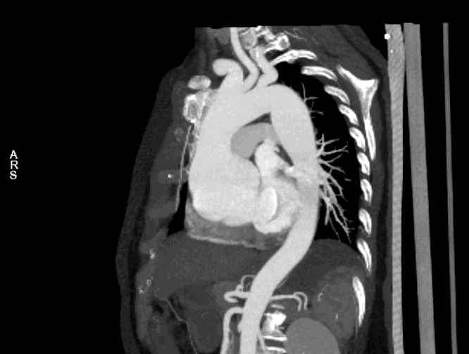 为什么叫哈巴狗钳2023学术荟萃｜王云：右侧肋间小切口体外循环心脏手术_https://www.jmylbn.com_新闻资讯_第11张