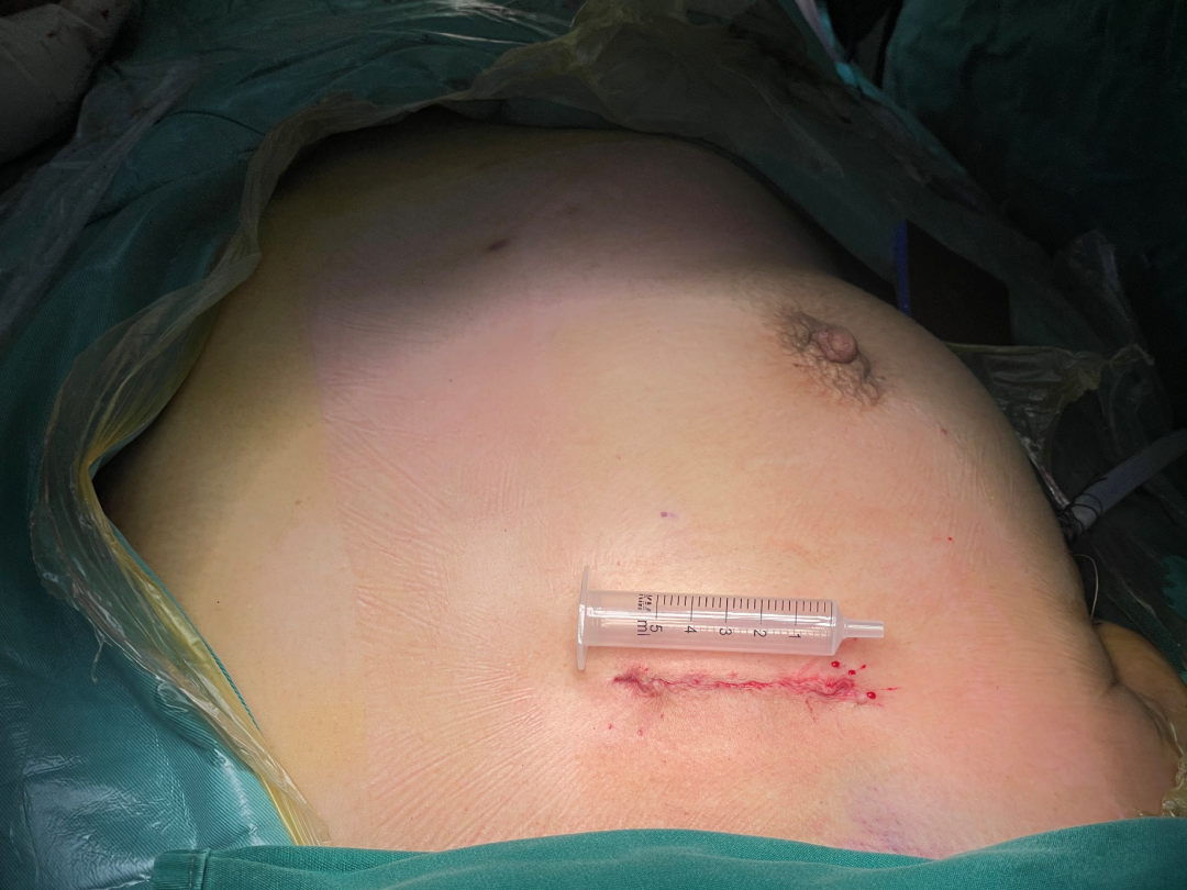 为什么叫哈巴狗钳2023学术荟萃｜王云：右侧肋间小切口体外循环心脏手术_https://www.jmylbn.com_新闻资讯_第16张