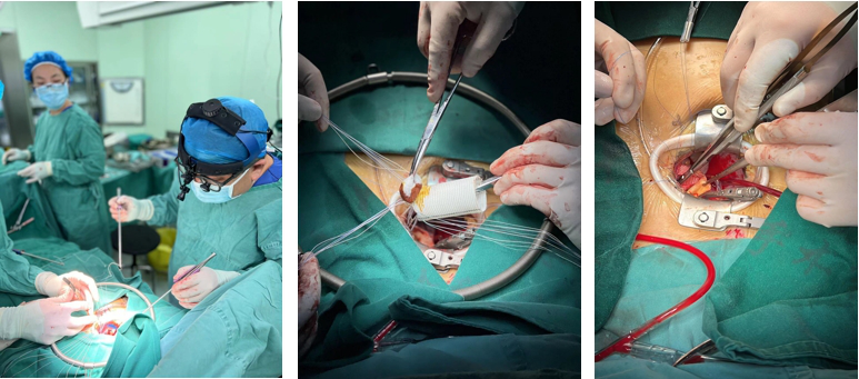 为什么叫哈巴狗钳2023学术荟萃｜王云：右侧肋间小切口体外循环心脏手术_https://www.jmylbn.com_新闻资讯_第13张