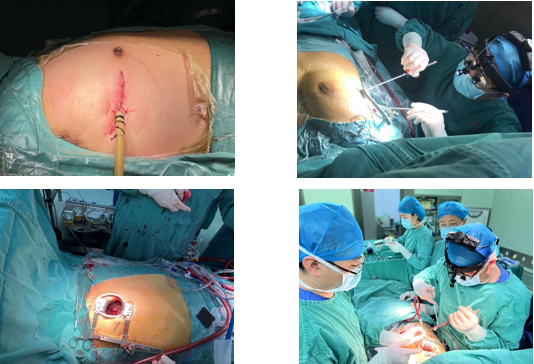 为什么叫哈巴狗钳2023学术荟萃｜王云：右侧肋间小切口体外循环心脏手术_https://www.jmylbn.com_新闻资讯_第8张