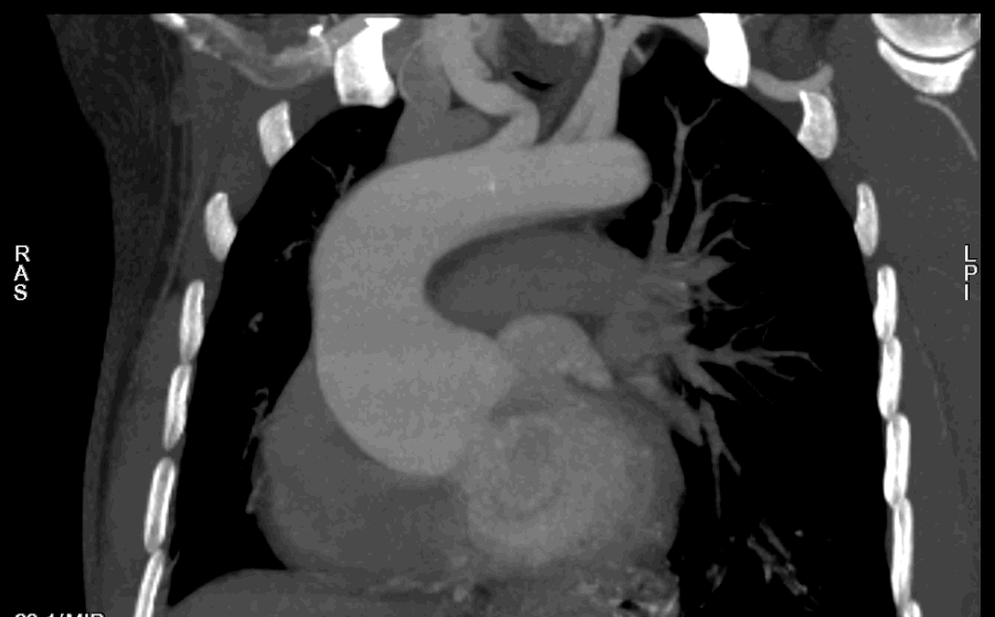 为什么叫哈巴狗钳2023学术荟萃｜王云：右侧肋间小切口体外循环心脏手术_https://www.jmylbn.com_新闻资讯_第9张