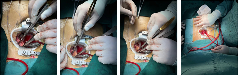 为什么叫哈巴狗钳2023学术荟萃｜王云：右侧肋间小切口体外循环心脏手术_https://www.jmylbn.com_新闻资讯_第14张