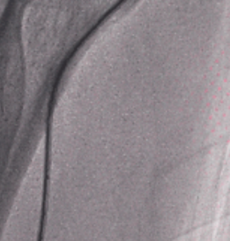 泥鳅导丝怎么用新心联播｜卢竞前：桡动脉入路困难的处理方法_https://www.jmylbn.com_新闻资讯_第11张