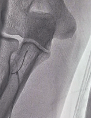 泥鳅导丝怎么用新心联播｜卢竞前：桡动脉入路困难的处理方法_https://www.jmylbn.com_新闻资讯_第8张