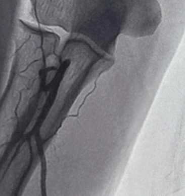 泥鳅导丝怎么用新心联播｜卢竞前：桡动脉入路困难的处理方法_https://www.jmylbn.com_新闻资讯_第7张