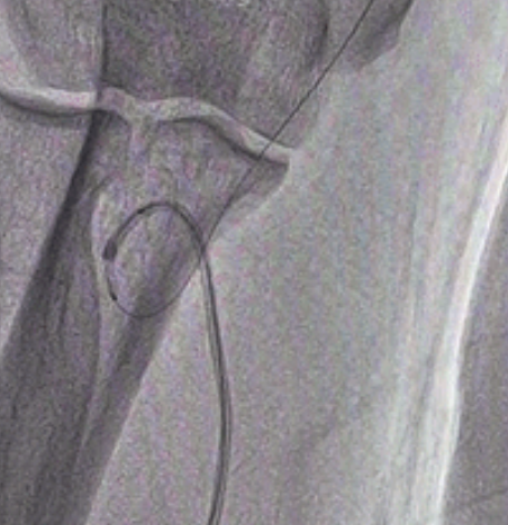 泥鳅导丝怎么用新心联播｜卢竞前：桡动脉入路困难的处理方法_https://www.jmylbn.com_新闻资讯_第9张