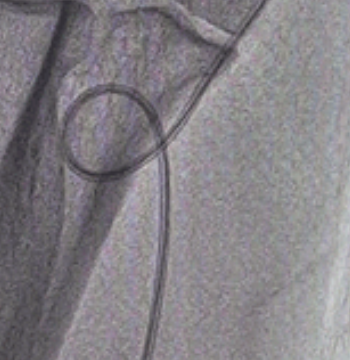 泥鳅导丝怎么用新心联播｜卢竞前：桡动脉入路困难的处理方法_https://www.jmylbn.com_新闻资讯_第10张