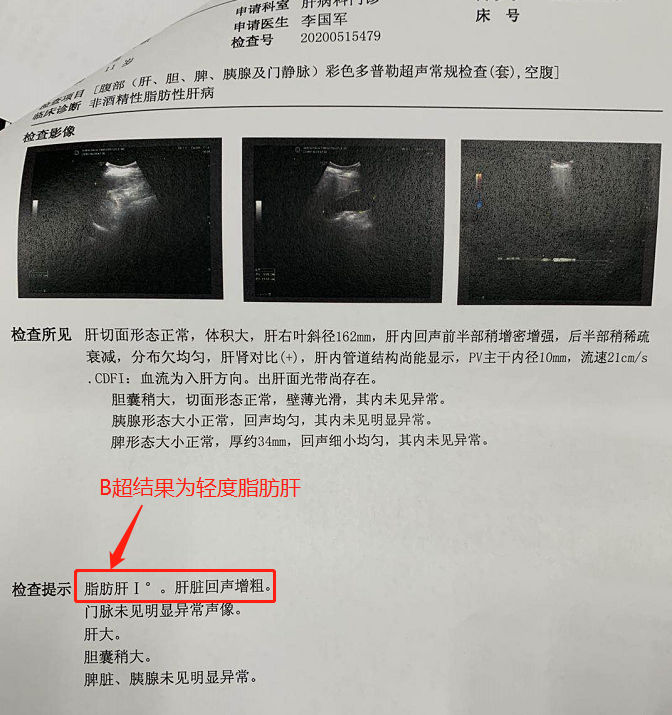 11歲男童得重度肝硬化！家長懵了：從小的「健康」習慣竟害了他 健康 第3張